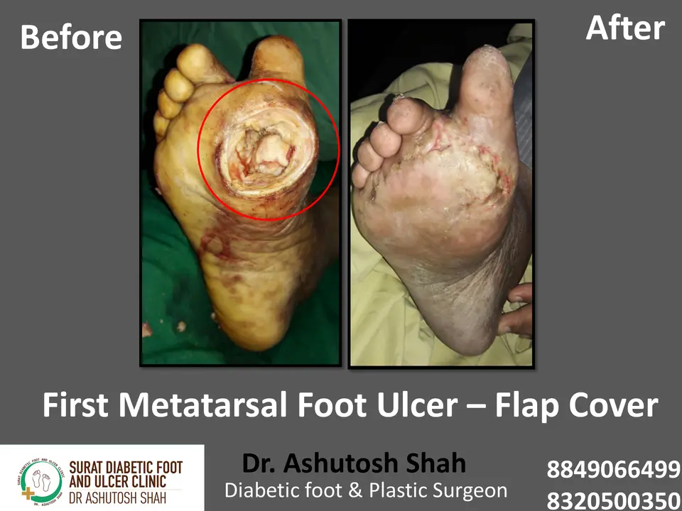 Diabetic Foot  PPT 3 checked by sir.pptx-67.webp